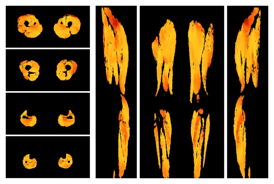 Muscle fiber tract angle map based on whole leg DTI based fiber tractography.