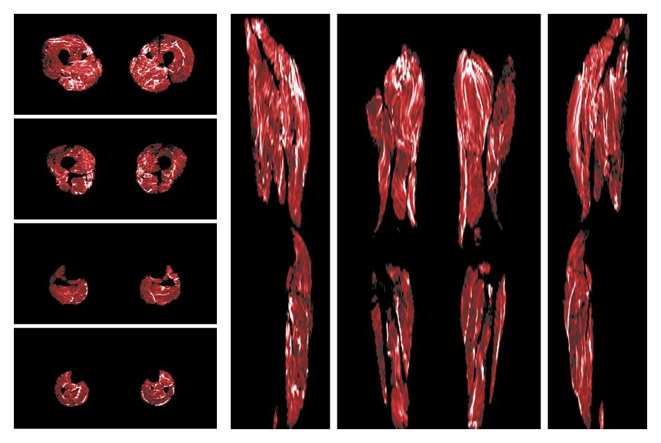 Muscle fiber tract density map based on whole leg DTI based fiber tractography.