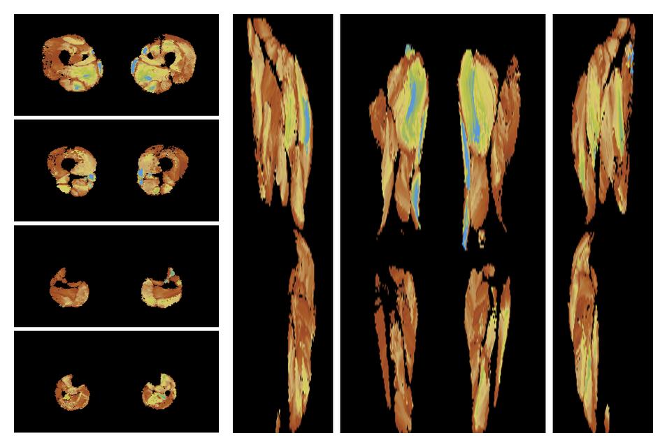 Muscle fiber tract length map based on whole leg DTI based fiber tractography.