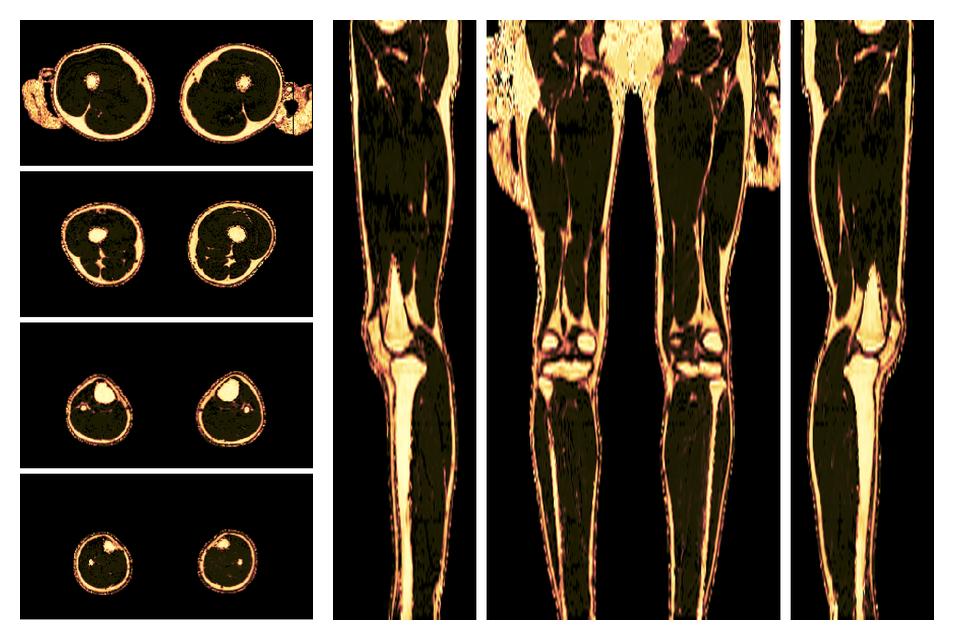 The fat fraction of the lower extremity obtained from the dixon reconstruction for muscle water fat quantification.