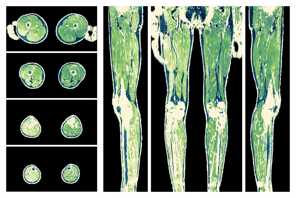 The R2 star relaxation time of the lower extremity obtained from the dixon reconstruction for muscle water fat quantification.