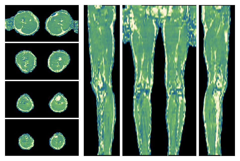 The water only T2 relaxation time of the lower extremity obtained from multi echo spin echo t2 mapping with EPG based reconstruction.