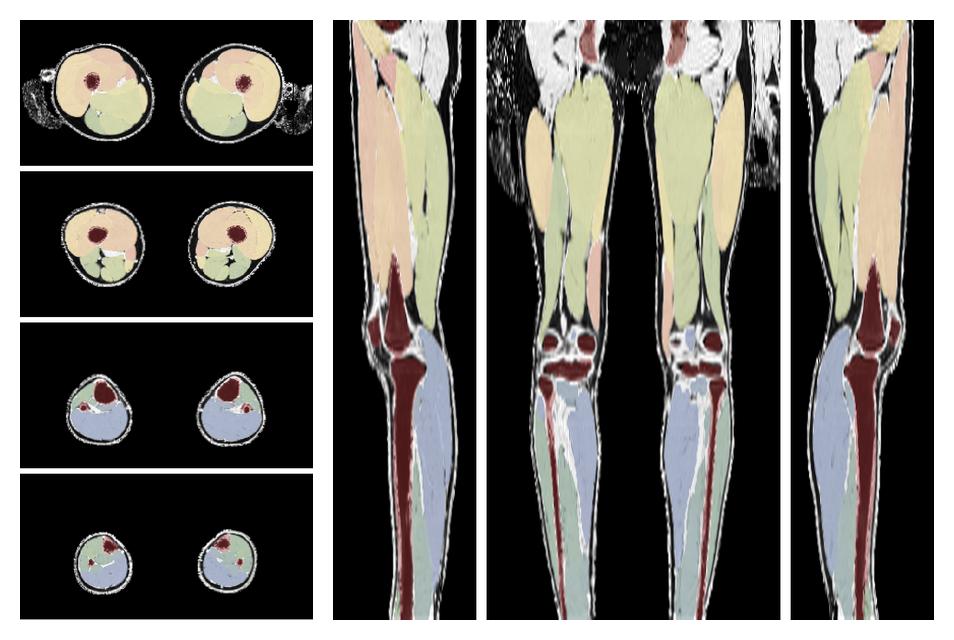 Overlay of automated muscle segmentation labels on dixon water image.