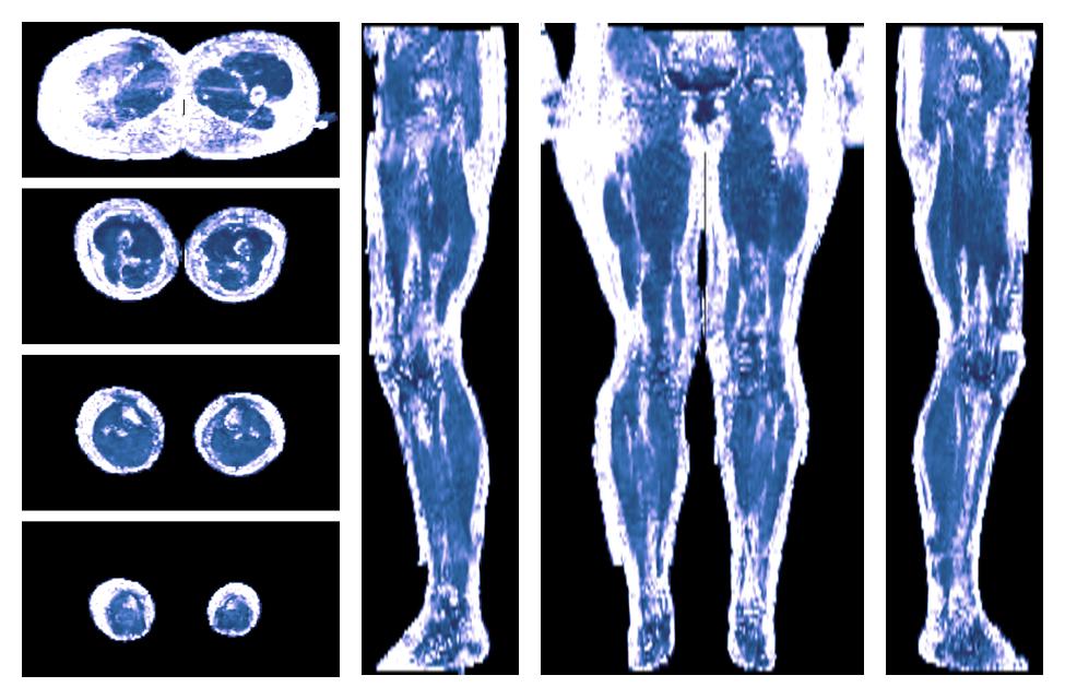 IVIM corrected whole leg muscle fractional anisotropy obtained from diffusion tensor imaging.