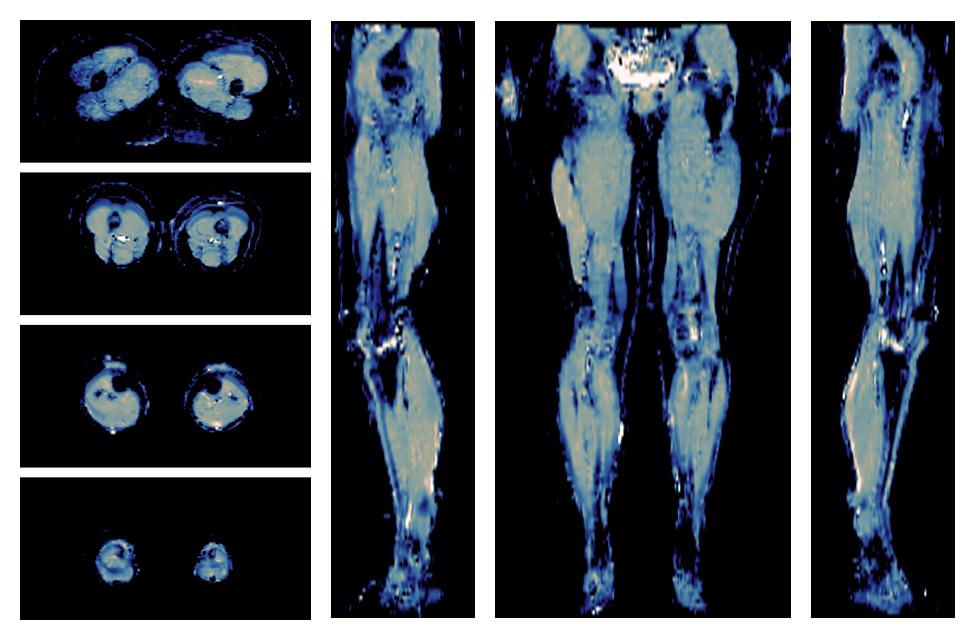 IVIM corrected whole leg muscle mean diffusivity obtained from diffusion tensor imaging.