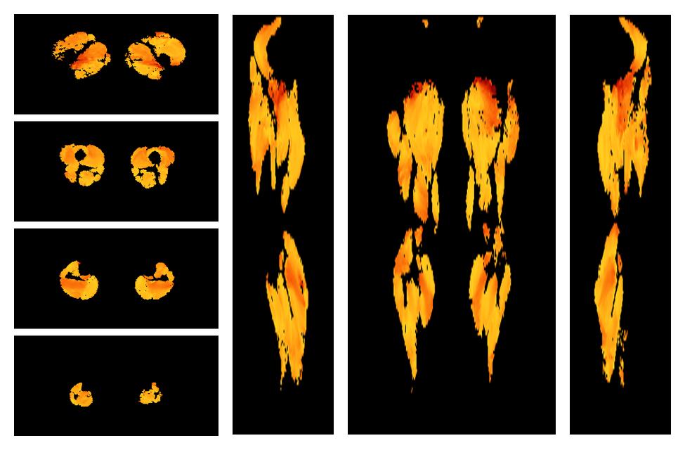 Muscle fiber tract angle map based on whole leg DTI based fiber tractography.