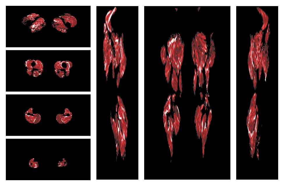 Muscle fiber tract density map based on whole leg DTI based fiber tractography.