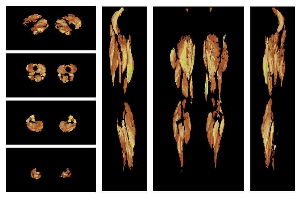 Muscle fiber tract length map based on whole leg DTI based fiber tractography.