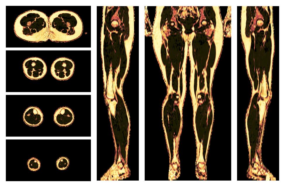 The fat fraction of the lower extremity obtained from the dixon reconstruction for muscle water fat quantification.