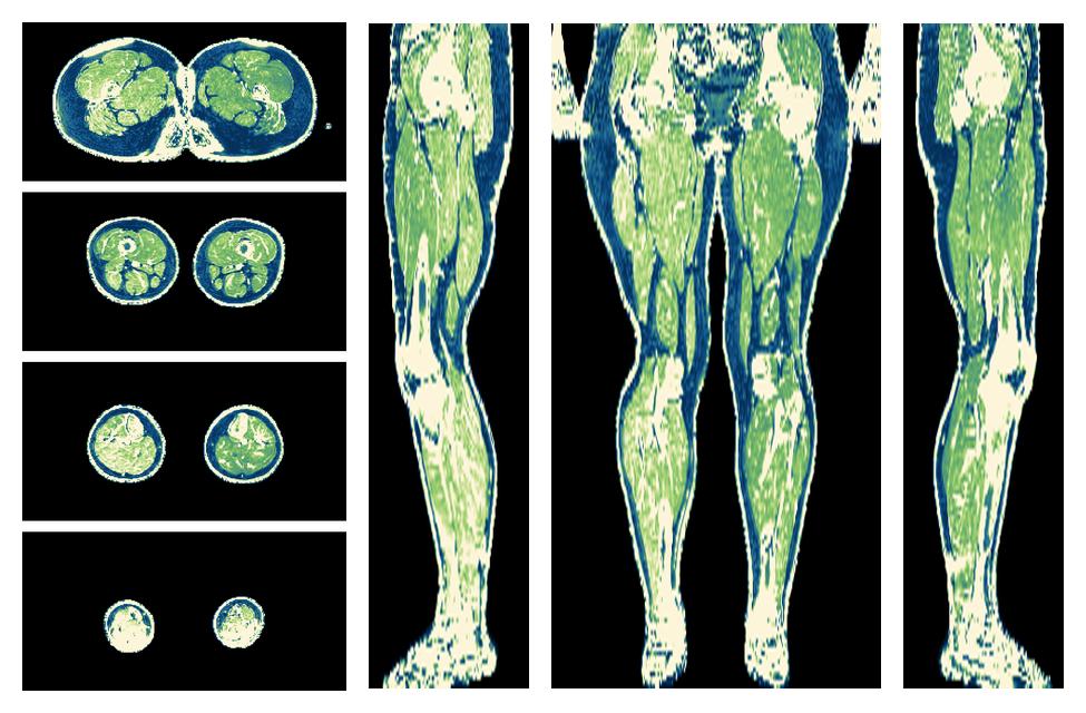 The R2 star relaxation time of the lower extremity obtained from the dixon reconstruction for muscle water fat quantification.