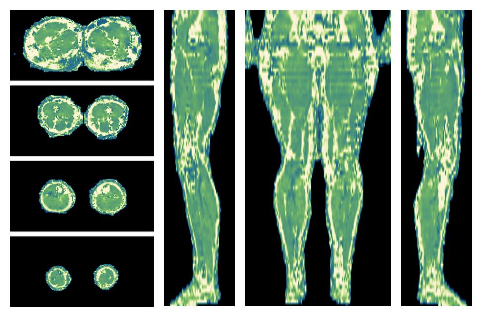 The water only T2 relaxation time of the lower extremity obtained from multi echo spin echo t2 mapping with EPG based reconstruction.