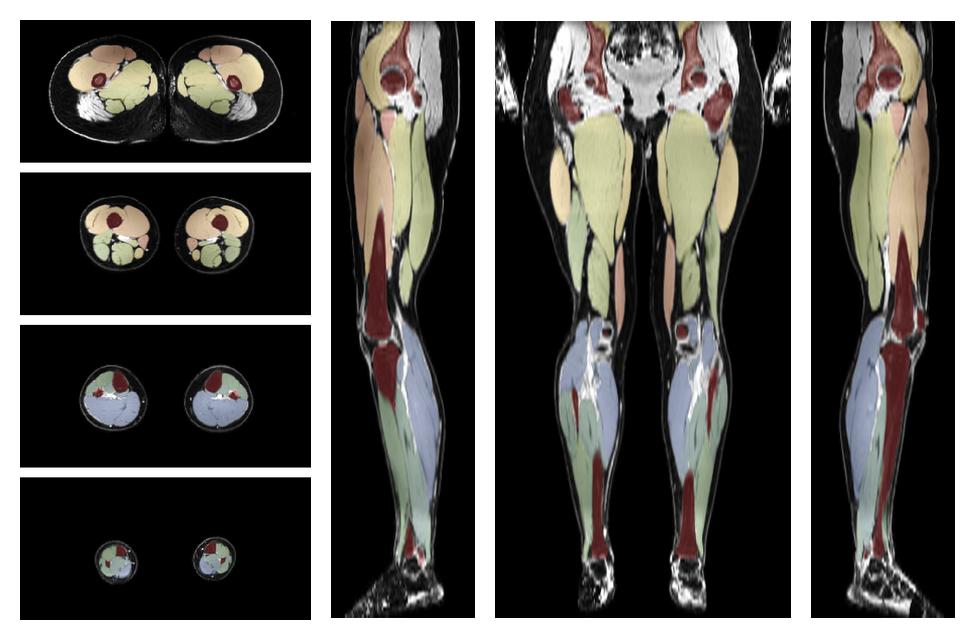 Overlay of automated muscle segmentation labels on dixon water image.