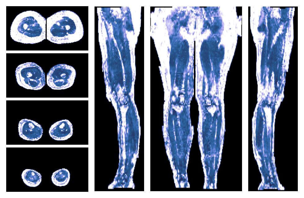 IVIM corrected whole leg muscle fractional anisotropy obtained from diffusion tensor imaging.