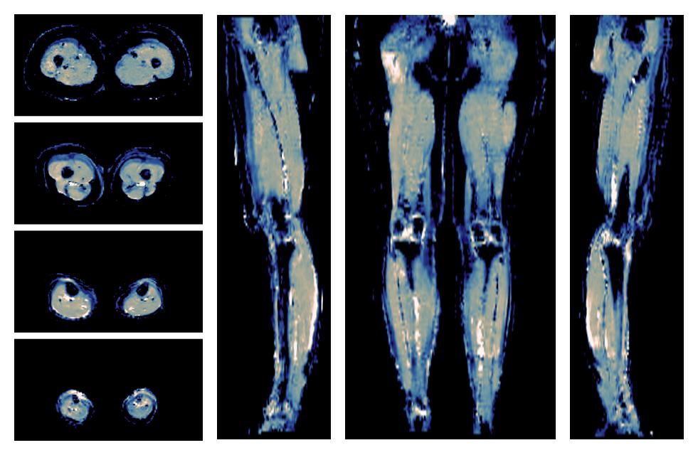 IVIM corrected whole leg muscle mean diffusivity obtained from diffusion tensor imaging.