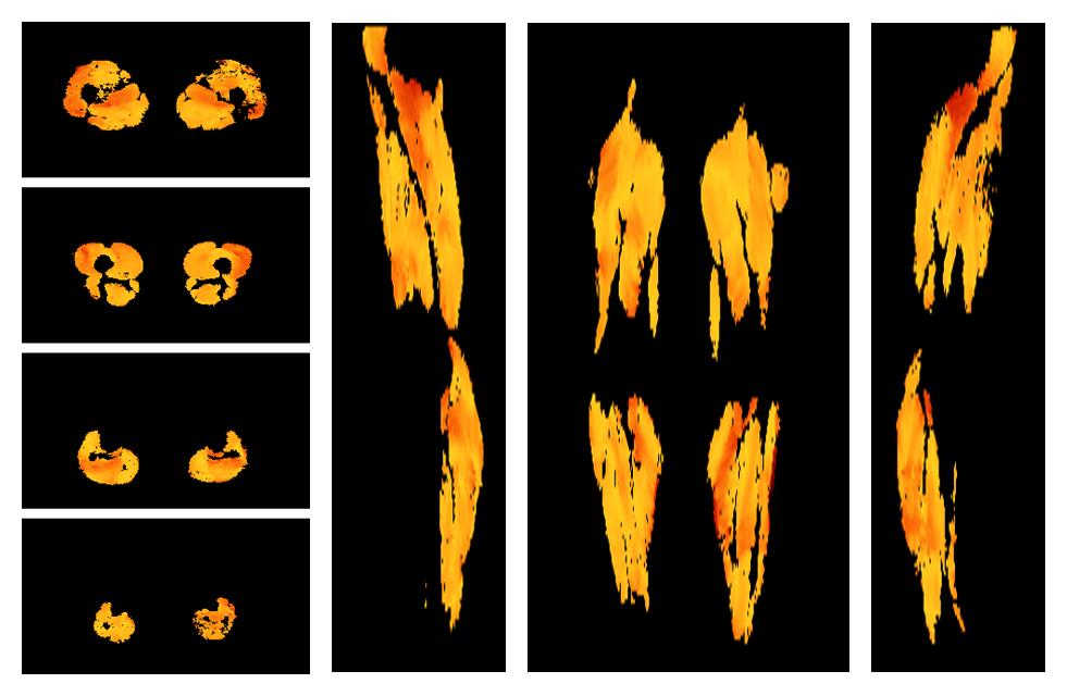 Muscle fiber tract angle map based on whole leg DTI based fiber tractography.