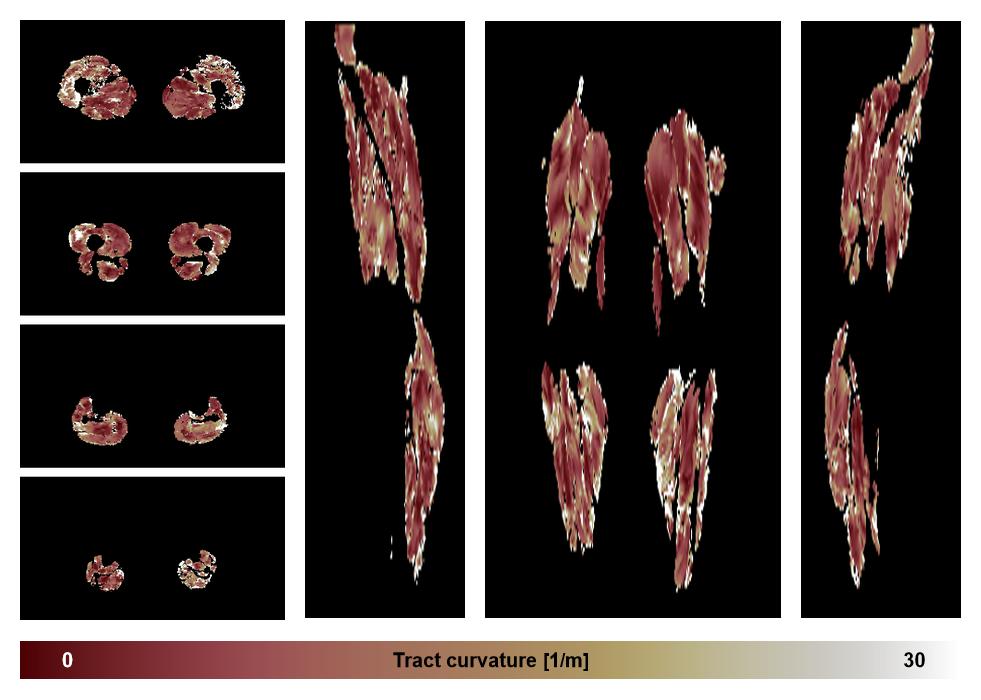 Muscle fiber tract curvature map based on whole leg DTI based fiber tractography.