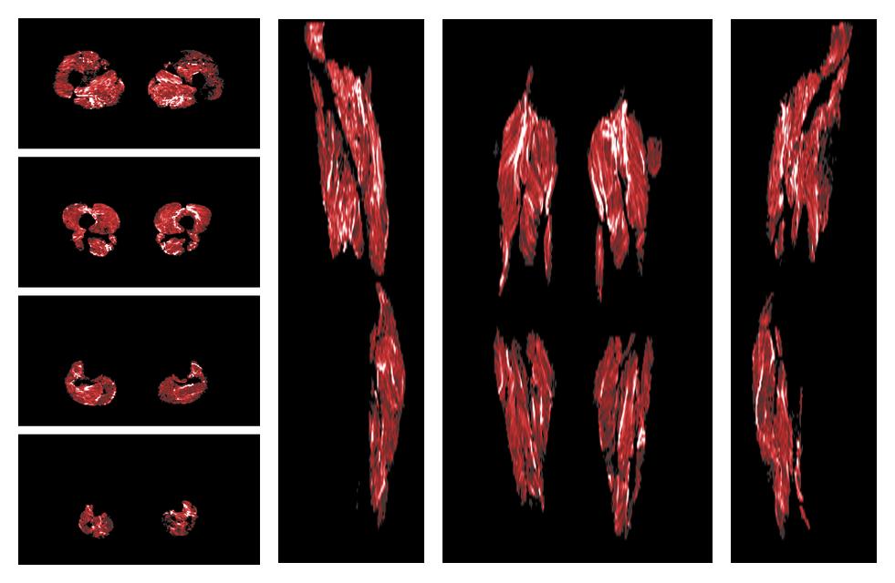 Muscle fiber tract density map based on whole leg DTI based fiber tractography.