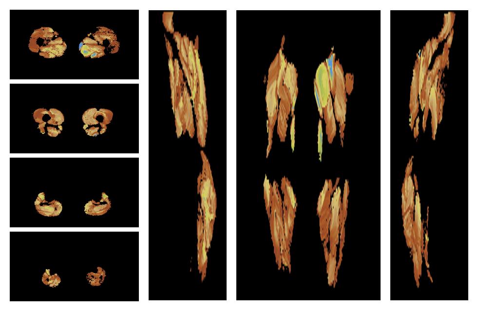 Muscle fiber tract length map based on whole leg DTI based fiber tractography.