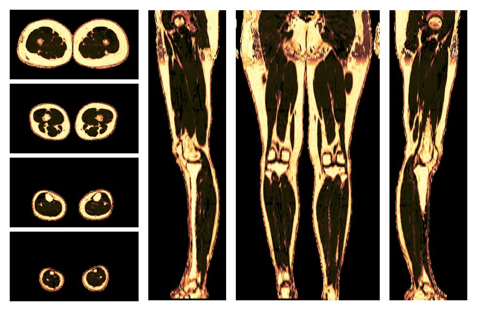 The fat fraction of the lower extremity obtained from the dixon reconstruction for muscle water fat quantification.