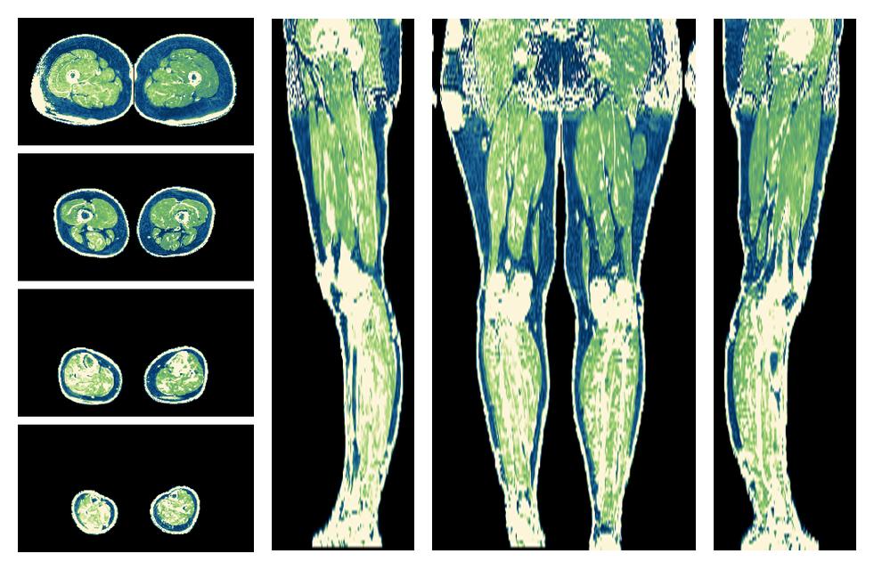 The R2 star relaxation time of the lower extremity obtained from the dixon reconstruction for muscle water fat quantification.