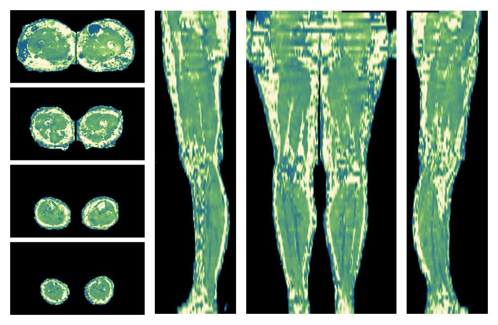 The water only T2 relaxation time of the lower extremity obtained from multi echo spin echo t2 mapping with EPG based reconstruction.