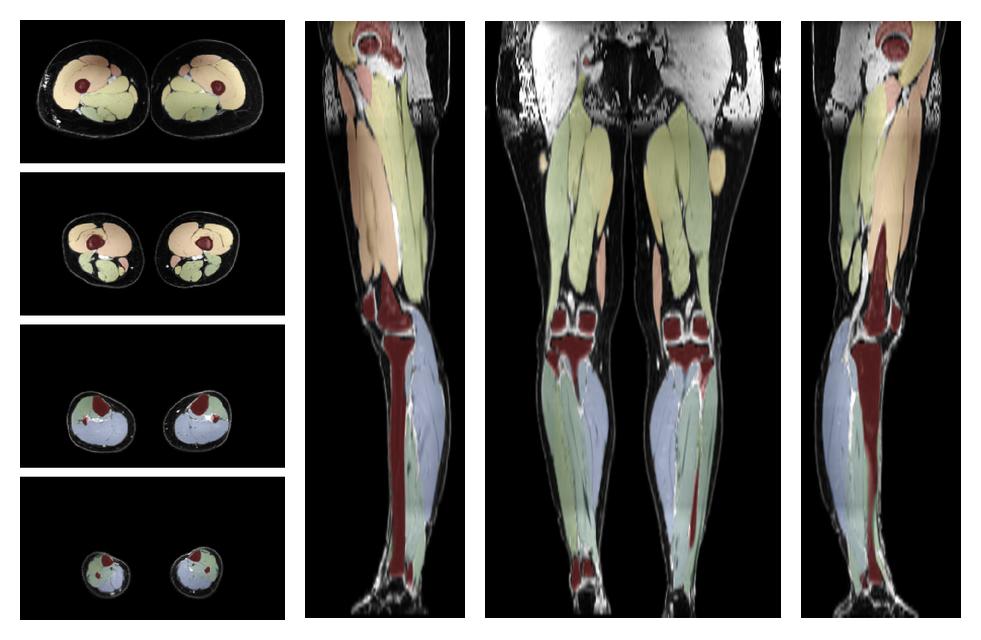 Overlay of automated muscle segmentation labels on dixon water image.