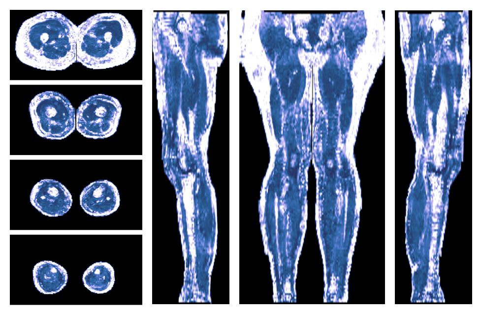 IVIM corrected whole leg muscle fractional anisotropy obtained from diffusion tensor imaging.