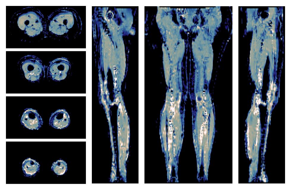 IVIM corrected whole leg muscle mean diffusivity obtained from diffusion tensor imaging.