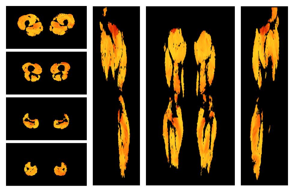 Muscle fiber tract angle map based on whole leg DTI based fiber tractography.