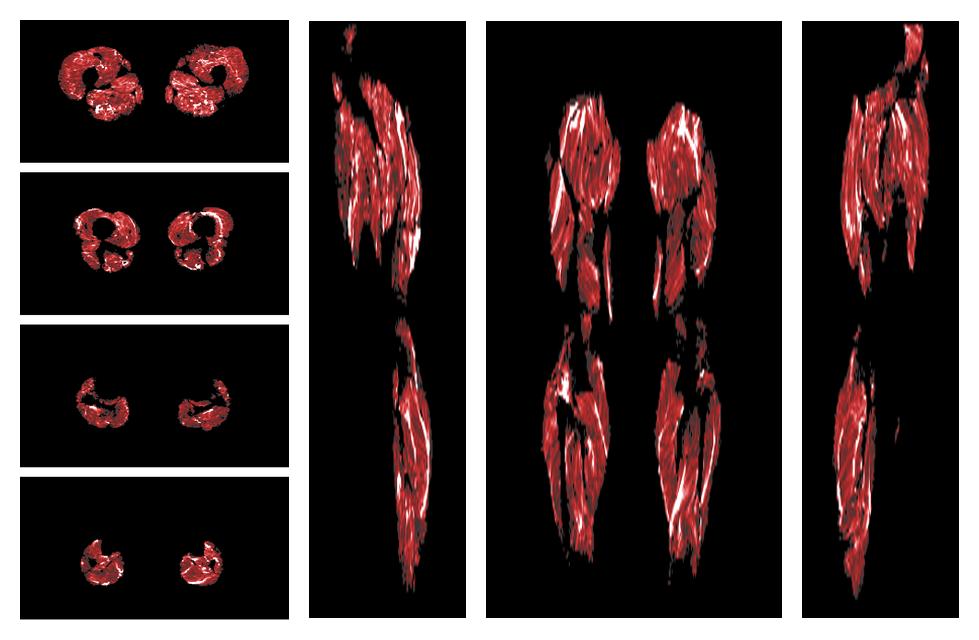 Muscle fiber tract density map based on whole leg DTI based fiber tractography.