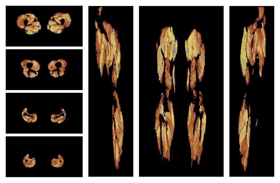 Muscle fiber tract length map based on whole leg DTI based fiber tractography.