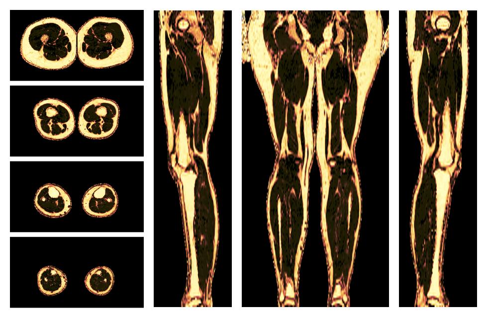 The fat fraction of the lower extremity obtained from the dixon reconstruction for muscle water fat quantification.