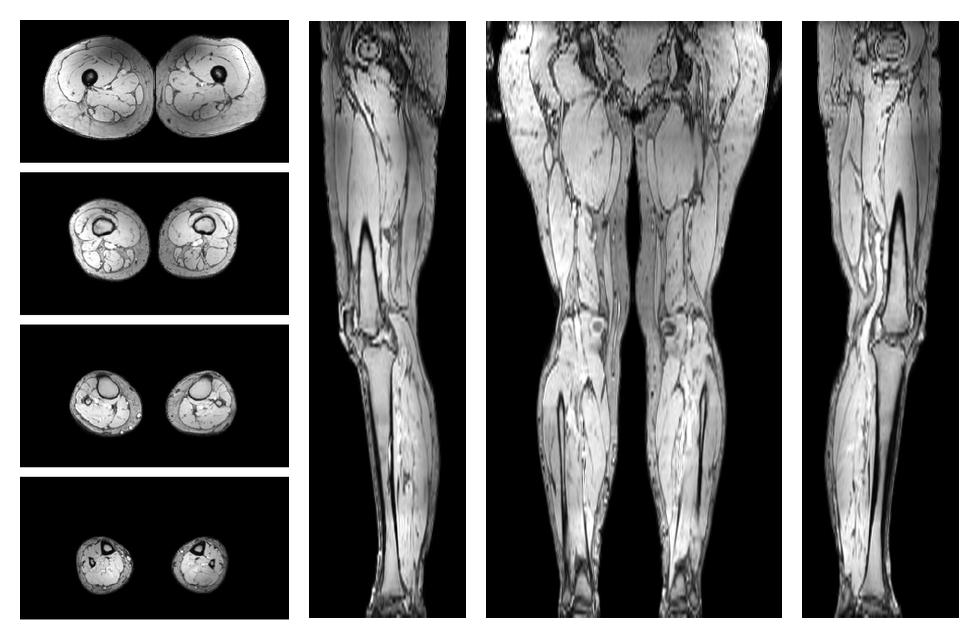 The out-phase image of the dixon reconstruction for water fat quantification.