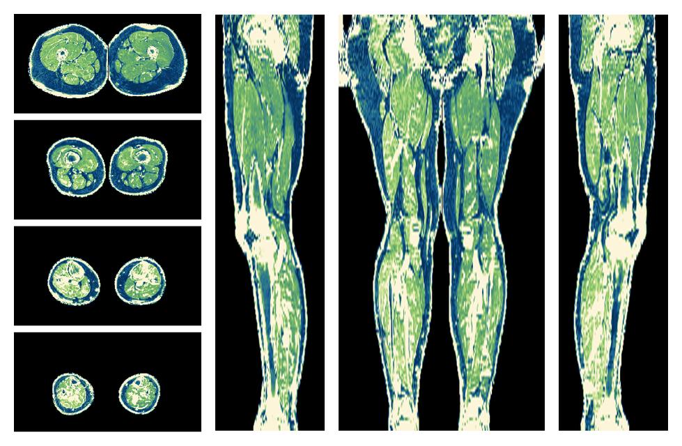 The R2 star relaxation time of the lower extremity obtained from the dixon reconstruction for muscle water fat quantification.