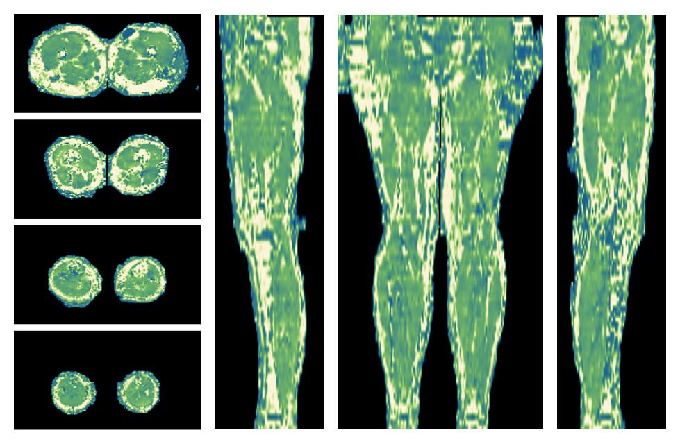 The water only T2 relaxation time of the lower extremity obtained from multi echo spin echo t2 mapping with EPG based reconstruction.