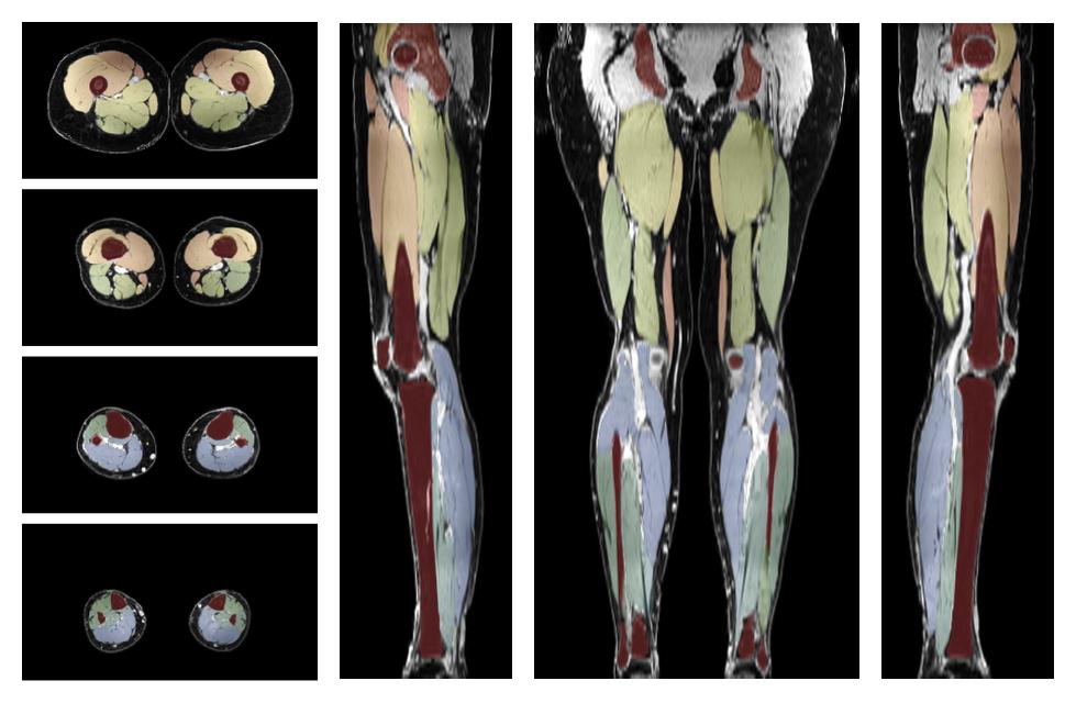 Overlay of automated muscle segmentation labels on dixon water image.