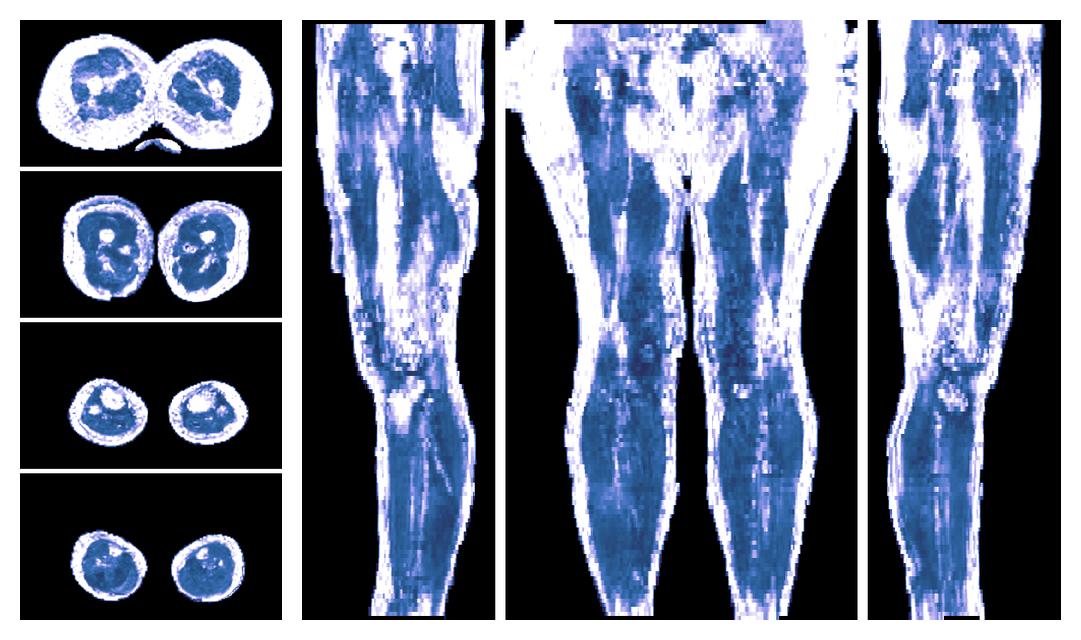 IVIM corrected whole leg muscle fractional anisotropy obtained from diffusion tensor imaging.