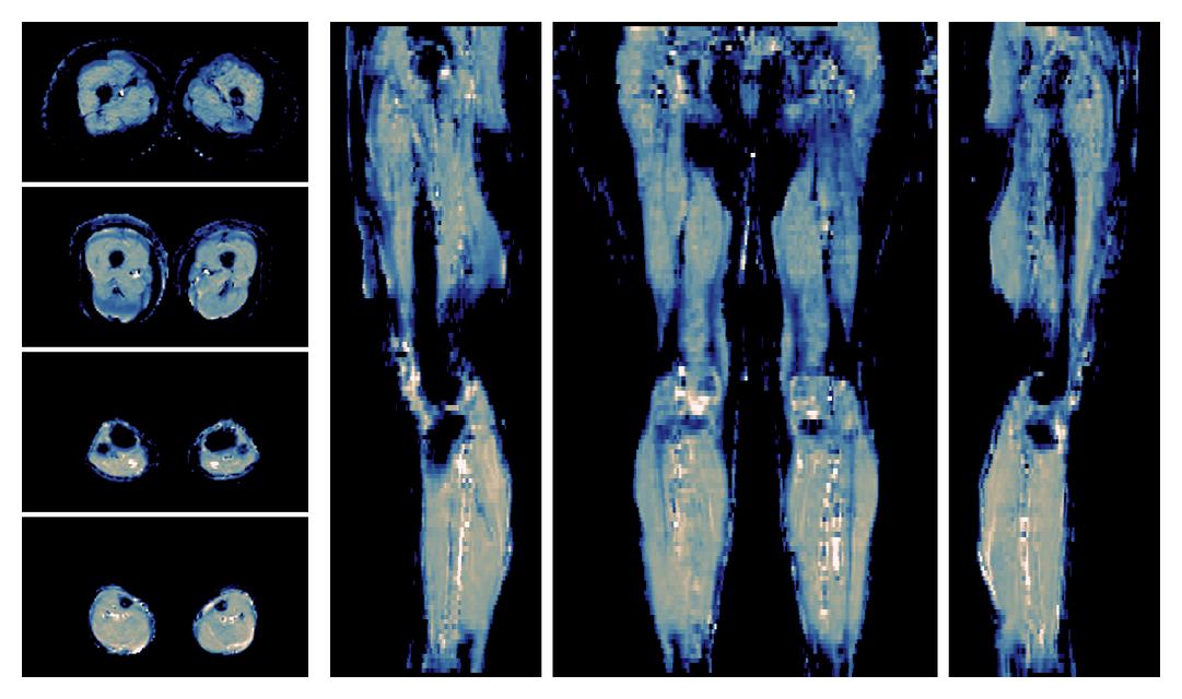 IVIM corrected whole leg muscle mean diffusivity obtained from diffusion tensor imaging.