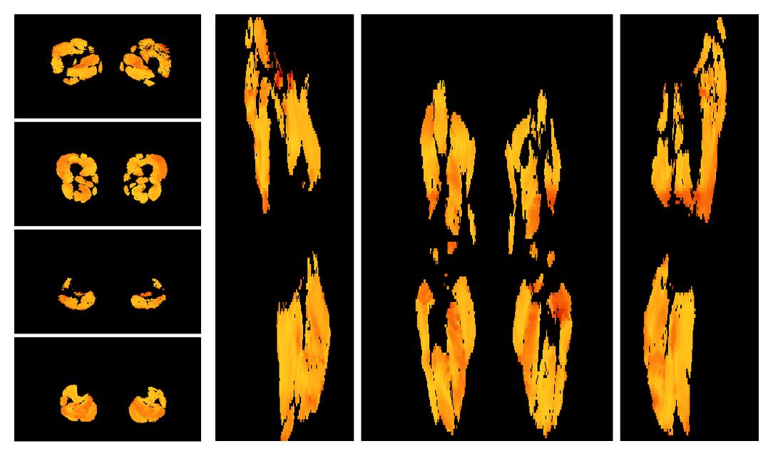 Muscle fiber tract angle map based on whole leg DTI based fiber tractography.