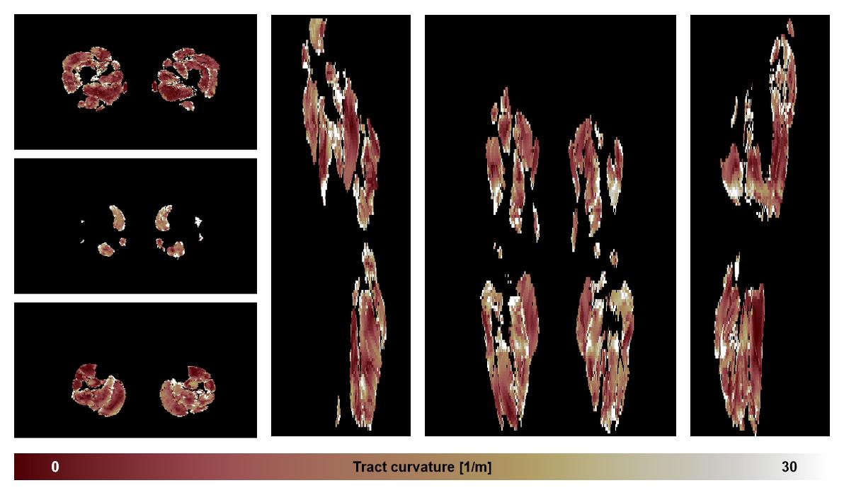 Muscle fiber tract curvature map based on whole leg DTI based fiber tractography.