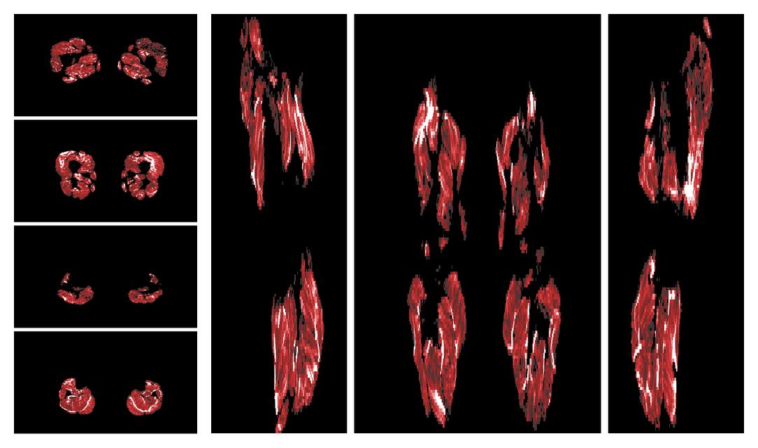 Muscle fiber tract density map based on whole leg DTI based fiber tractography.