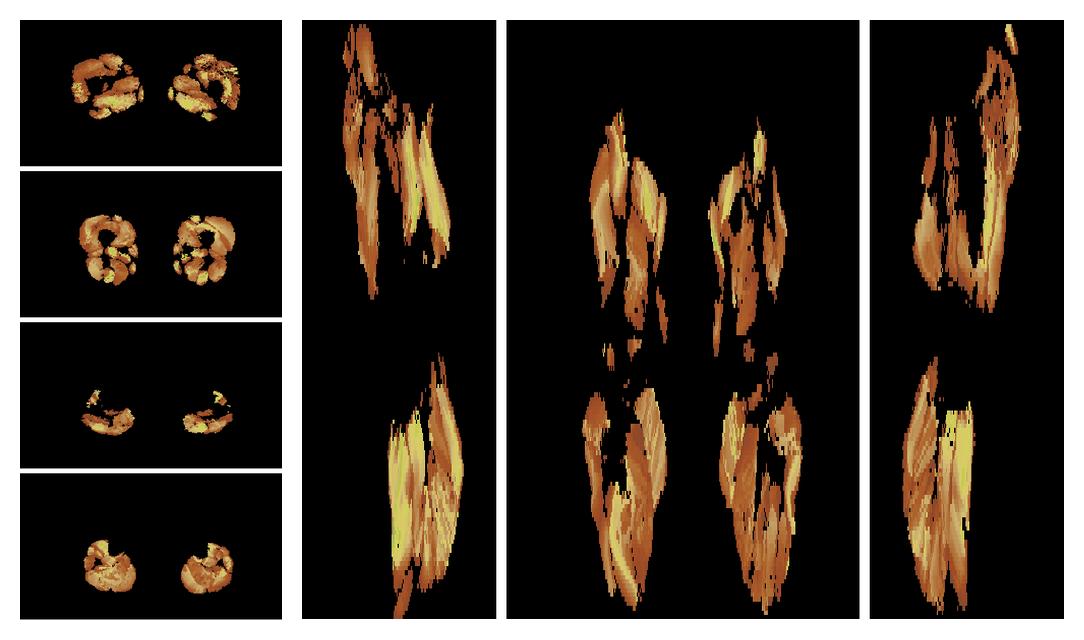 Muscle fiber tract length map based on whole leg DTI based fiber tractography.