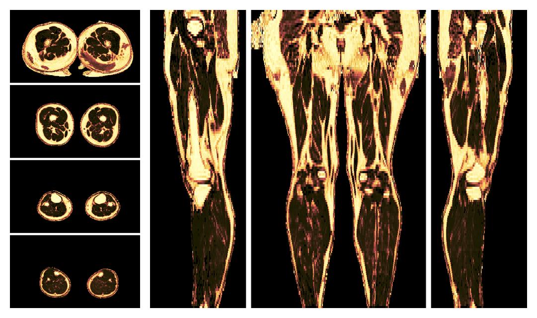 The fat fraction of the lower extremity obtained from the dixon reconstruction for muscle water fat quantification.