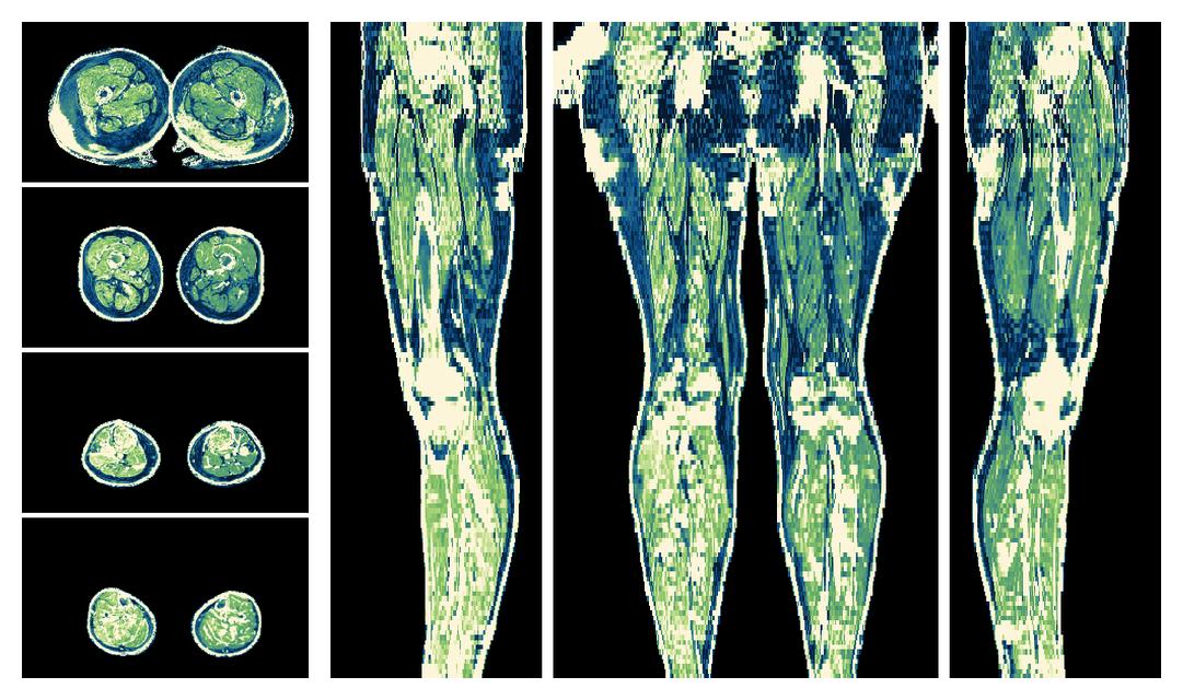 The R2 star relaxation time of the lower extremity obtained from the dixon reconstruction for muscle water fat quantification.