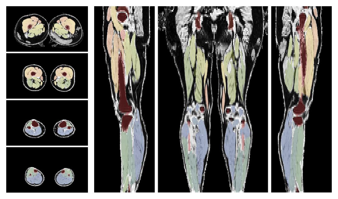 Overlay of automated muscle segmentation labels on dixon water image.