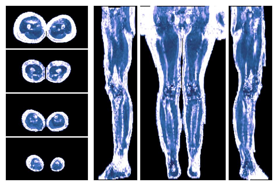 IVIM corrected whole leg muscle fractional anisotropy obtained from diffusion tensor imaging.