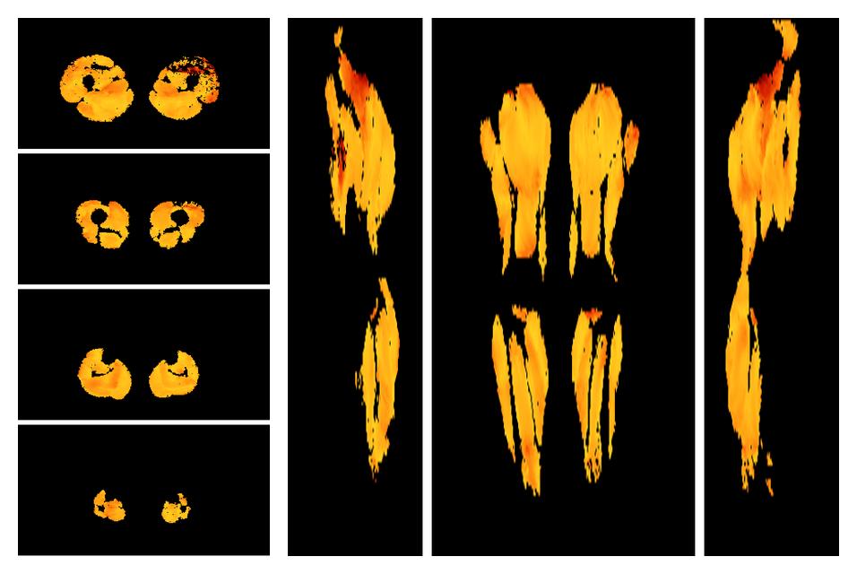 Muscle fiber tract angle map based on whole leg DTI based fiber tractography.