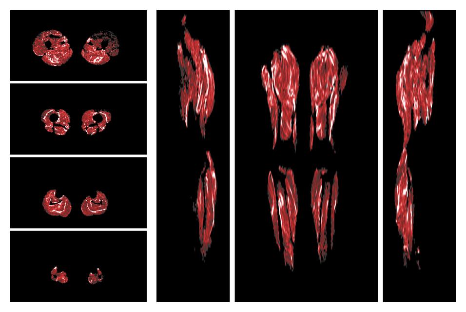 Muscle fiber tract density map based on whole leg DTI based fiber tractography.