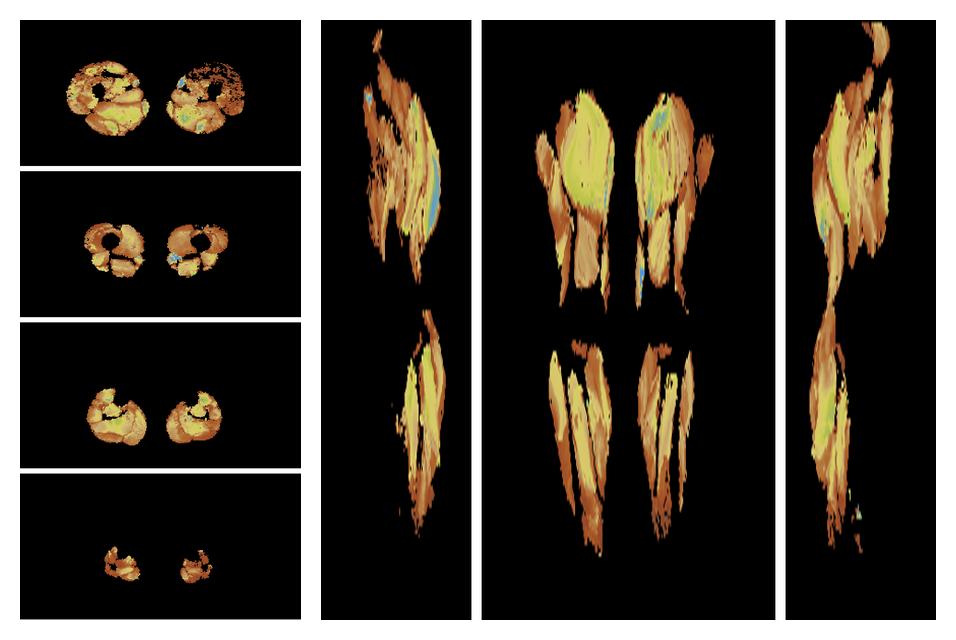 Muscle fiber tract length map based on whole leg DTI based fiber tractography.