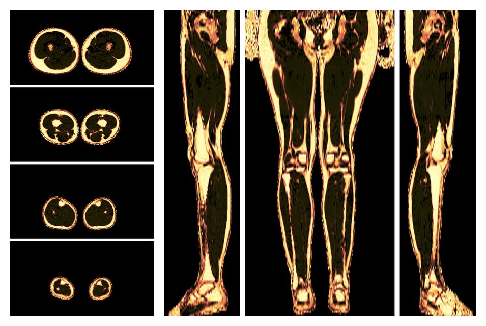 The fat fraction of the lower extremity obtained from the dixon reconstruction for muscle water fat quantification.